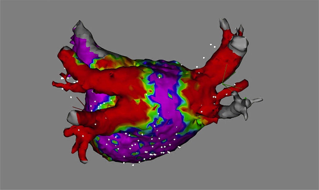 Antral PFA lesions persisted at 3-month remapping.