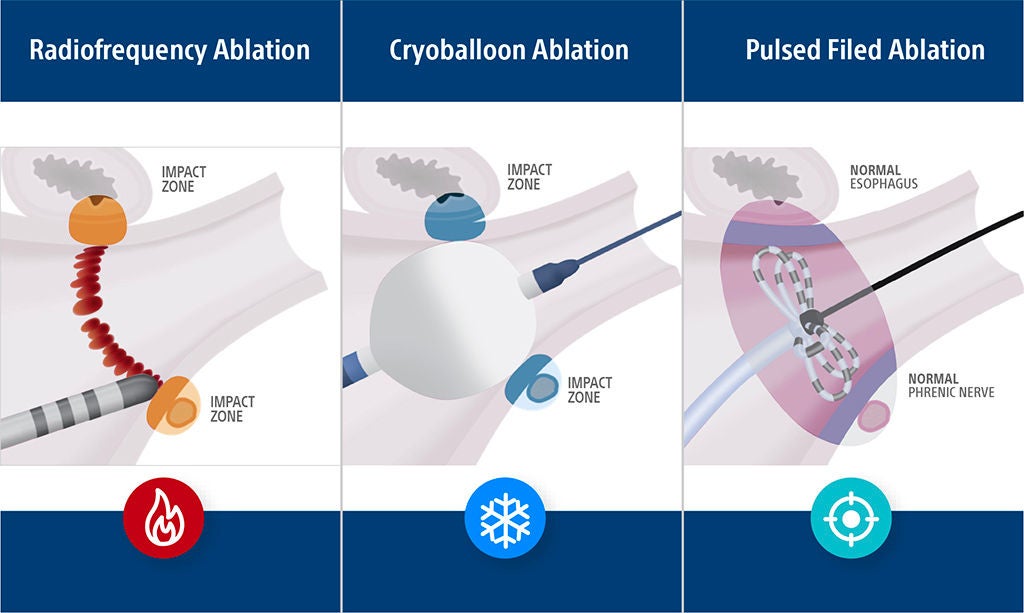 image representaton of ablation.