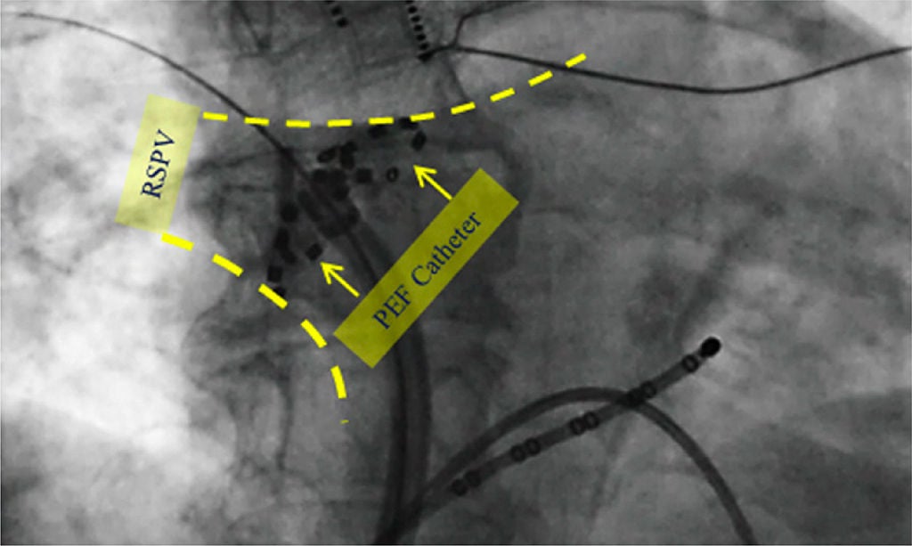 Ultra-rapid, tissue-selective ablation: both epicardial and endocardial.