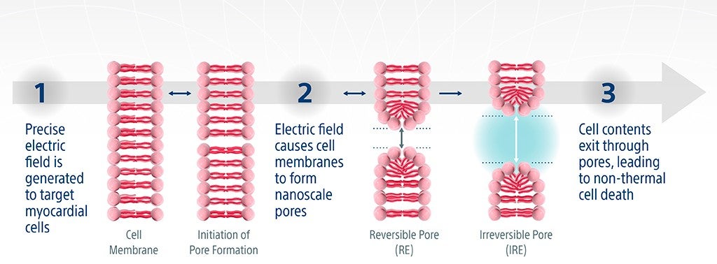 irreversible electroporation graphically representation image