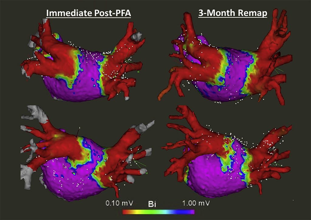 Illustration showing post-pfa mapping.