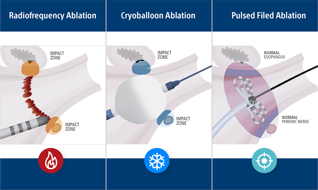 image representaton of ablation.