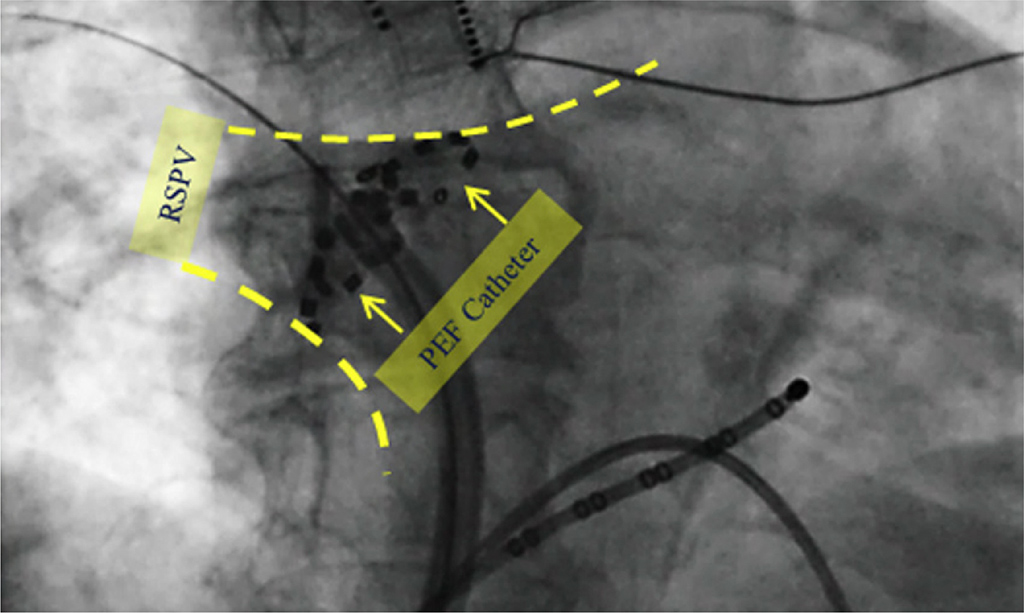 Ultra-rapid, tissue-selective ablation: both epicardial and endocardial.