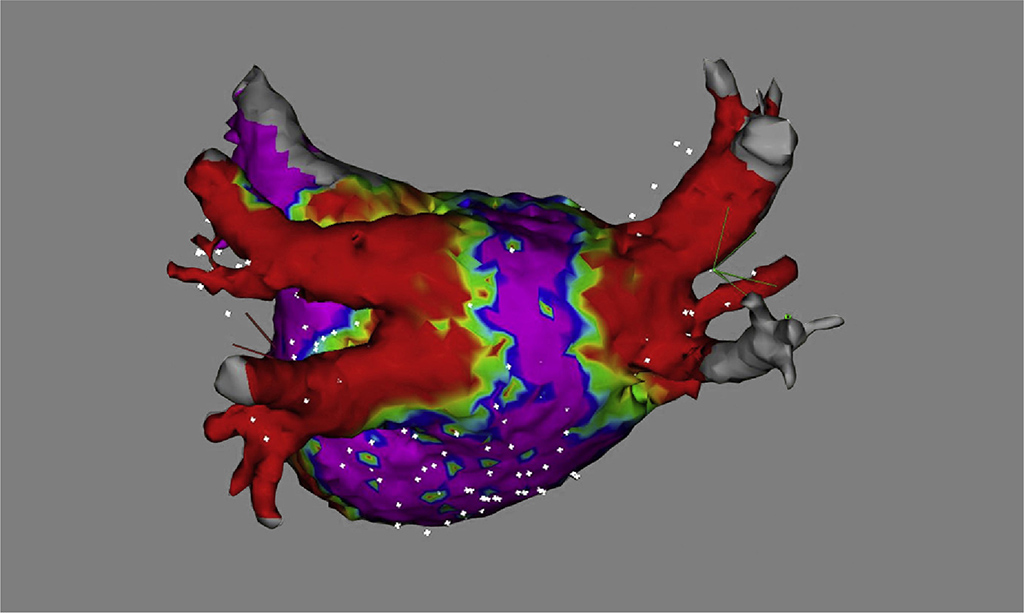 Antral PFA lesions persisted at 3-month remapping.