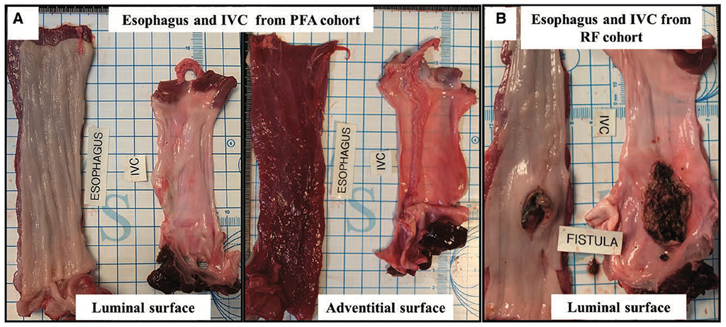 Pulsed Field Ablation Versus Radiofrequency Ablation