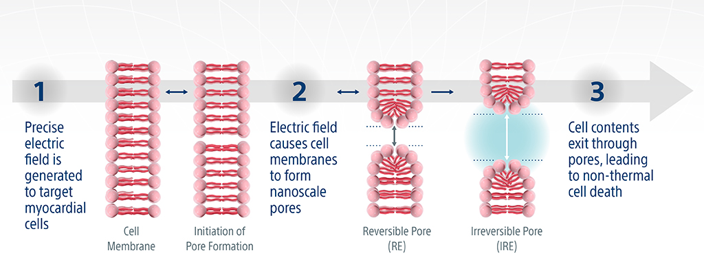 irreversible electroporation graphically representation image