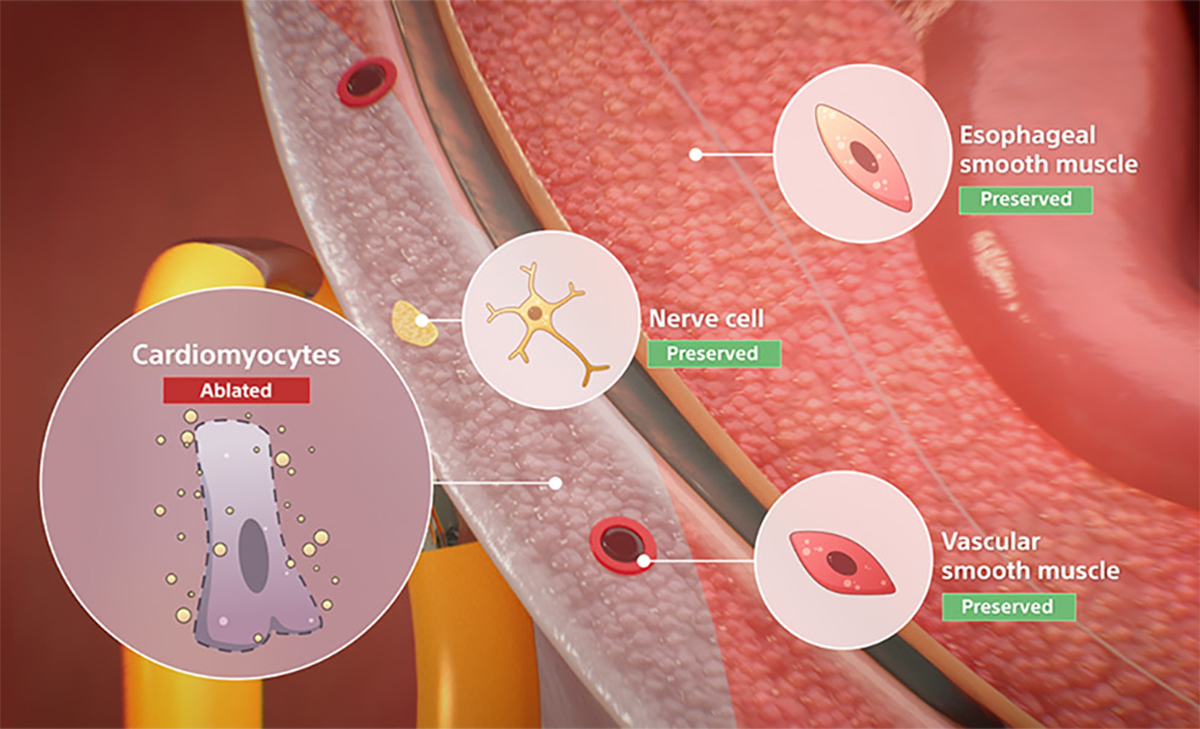 Tissue Selective ablation